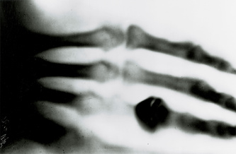 Roentgen's X-ray, 1895.